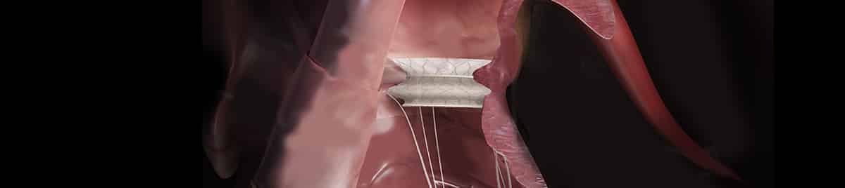 Mitral valve banner