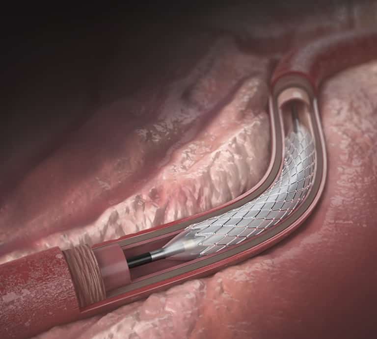 PTFE Covered Stent Aran Biomedical