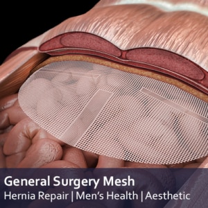 General Surgery mesh Applications - resorbable, non resorbale and semi-resorbable mesh