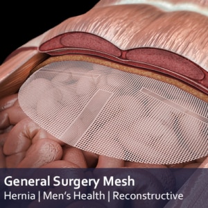 General Surgery mesh Applications - resorbable, non resorbale and semi-resorbable mesh