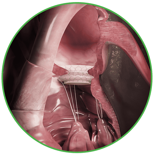 Low profile stent cover fabric Low profile stent cover fabric