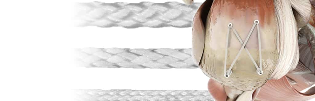 High-Strength-Sutures-1024x330